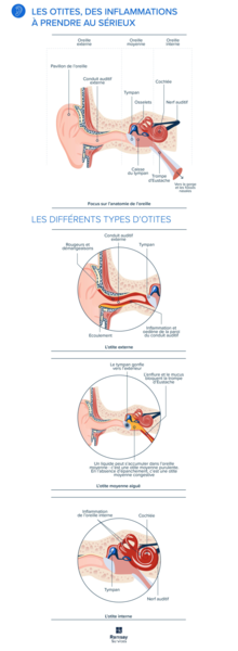 Les Otites